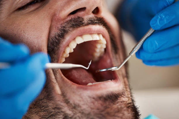Best Broken or Chipped Tooth Repair in Reno, OH